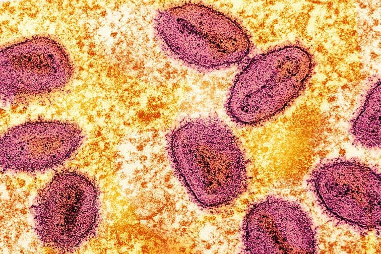 Filipinler’de de yeni mpox vakası görüldü..